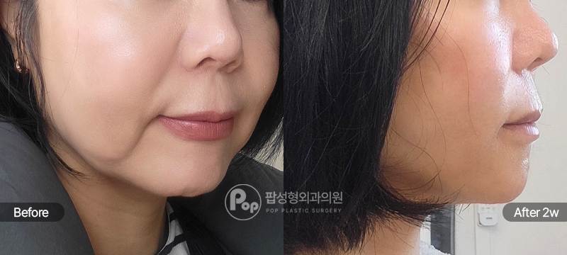 50대 안면거상 2주차 측면 경과 이미지