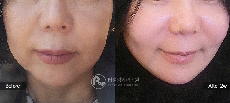 50대 안면거상 2주차 정면 경과 이미지