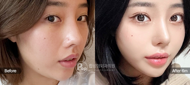 자연유착 눈재수술과 실리프팅 6개월차 경과 이미지