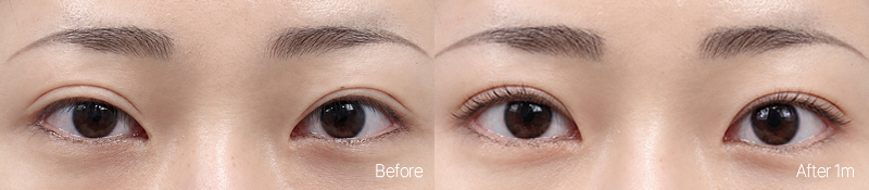 아웃라인과 눈 앞머리 구조를 함께 고려한 CASE 03