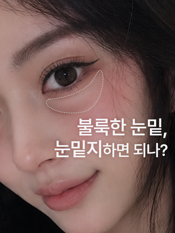 눈밑이 불룩한데 눈밑지방재배치만 하면 되는지 상담 이미지