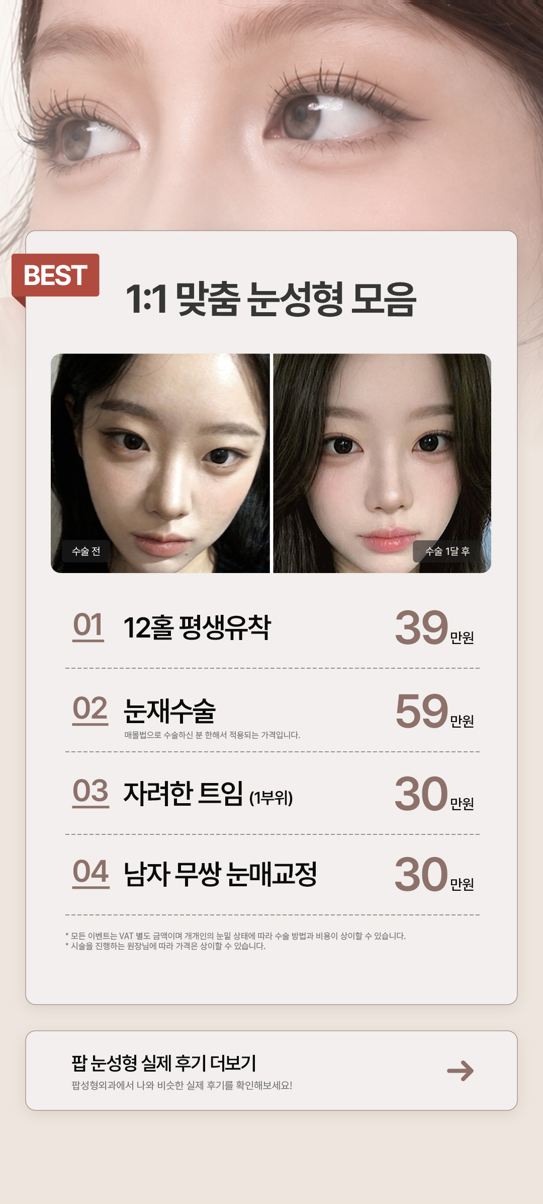 팝 눈성형 1:1 맞춤 눈성형 모음