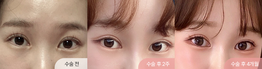 이마거상 2주차·4개월차 경과 이미지