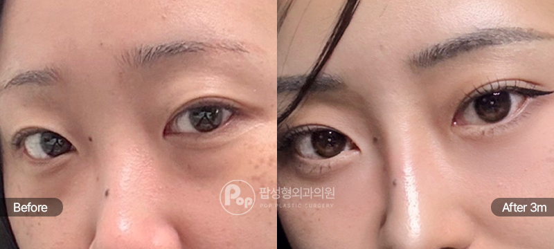 자연유착 + 윗트임 + 눈밑지방재배치 3개월차 경과 이미지