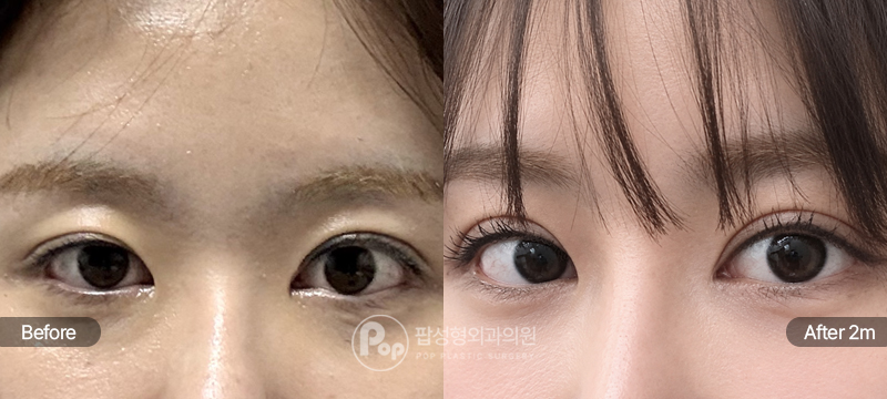 자연유착 + 앞트임복원술 + 눈매교정 2개월차 경과 이미지