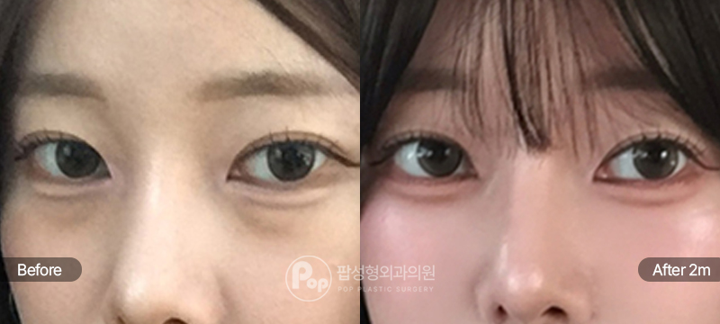 눈밑지방재배치 2개월차 경과 이미지