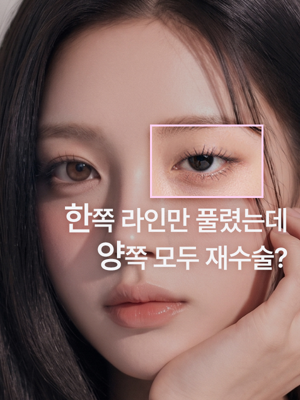 한쪽 쌍꺼풀만 풀렸을 때 양쪽 재수술 여부 상담 이미지