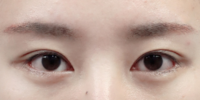 앞트임 복원 AFTER 이미지
