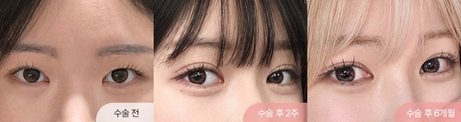 눈재수술 자연유착 인아웃라인 6개월차 경과 이미지