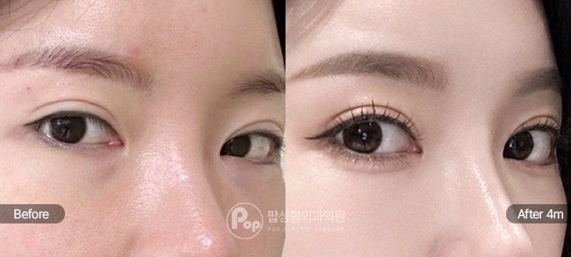 눈재수술 자연유착 눈매교정 앞·뒤·밑트임 4개월차 경과 이미지