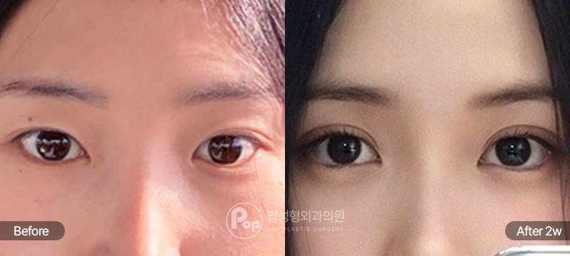 12홀 자연유착 윗트임 앞·뒤·밑트임 2주차 경과 이미지