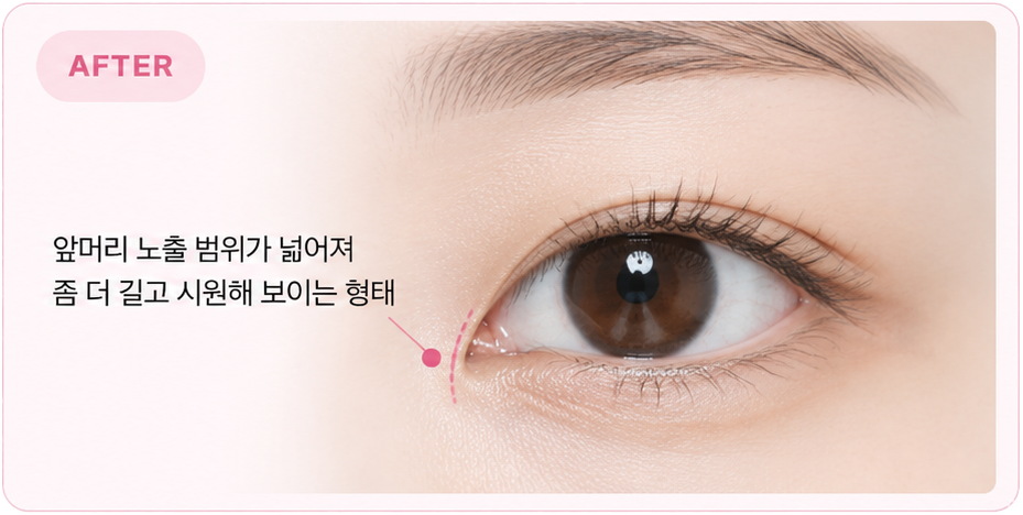 앞머리 노출 범위가 넓어져 길고 시원해 보이는 AFTER 형태
