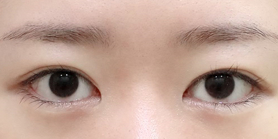 눈 구조와 어울리지 않는 라인