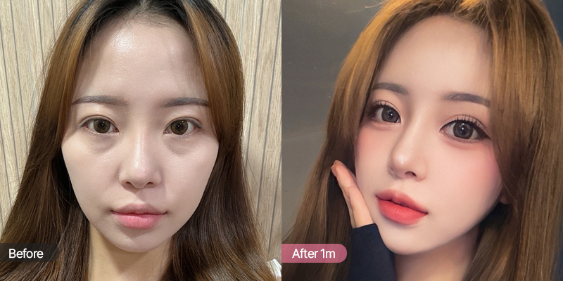 세미아웃에서 아웃라인으로 높이고 싶은 CASE 02
