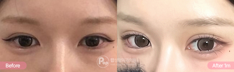 12홀 자연유착 윗트임 뒤밑트임 1개월차 경과 이미지