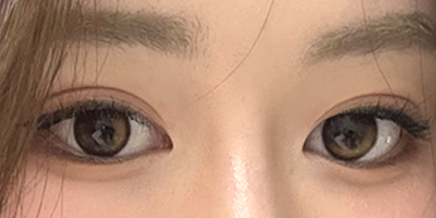 쌍꺼풀 수술 1달 후 모습