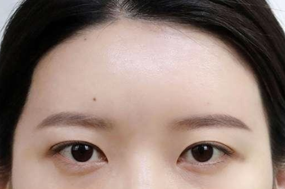 답답한 눈매 이마실리프팅 전