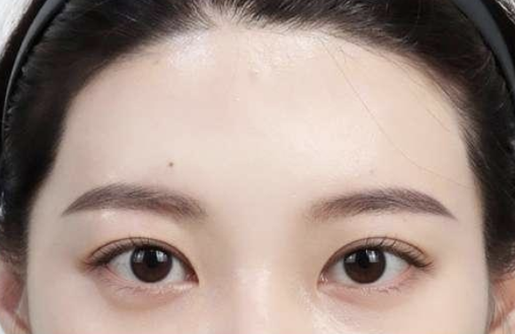 답답한 눈매 이마실리프팅 1주 후