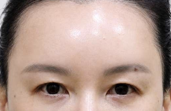 눈과 눈썹 사이가 좁은 경우 이마실리프팅 전