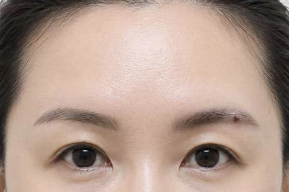 눈과 눈썹 사이가 좁은 경우 이마실리프팅 1주 후