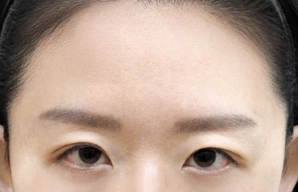이마로 눈을 뜨는 경우 이마실리프팅 전