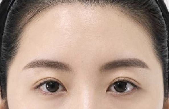 이마로 눈을 뜨는 경우 이마실리프팅 2주 후
