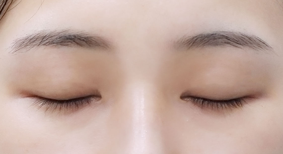 쌍꺼풀 수술 후 눈을 감은 모습 확인 예시