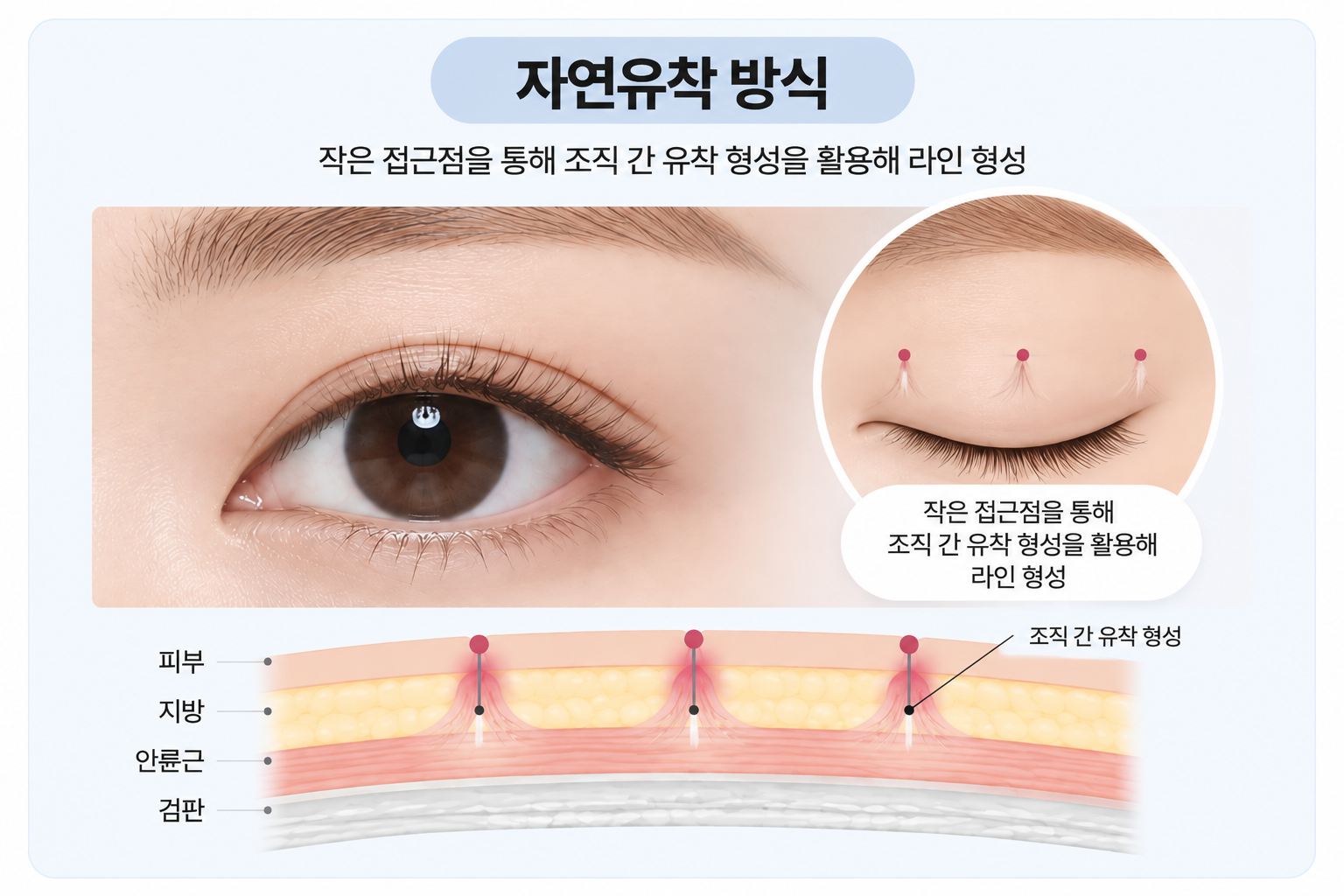 자연유착 방식 설명 이미지