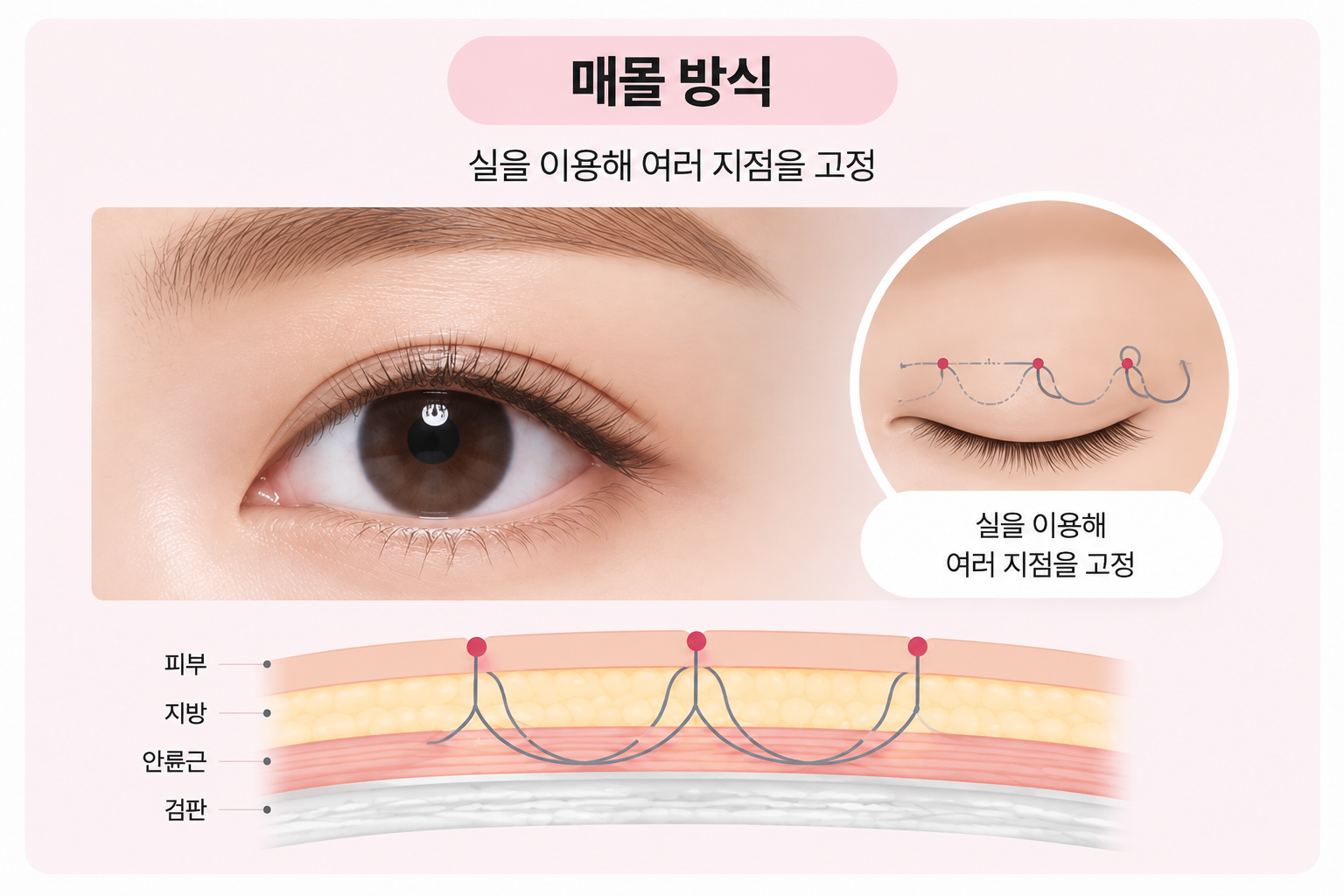 매몰 방식 설명 이미지