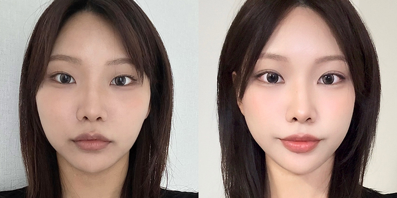 인아웃라인 전후 3개월 사례