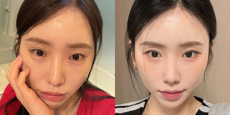 쌍꺼풀 전후 1개월 사례
