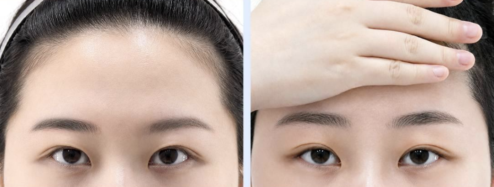 눈썹을 들어 올렸을 때 눈매 변화 비교