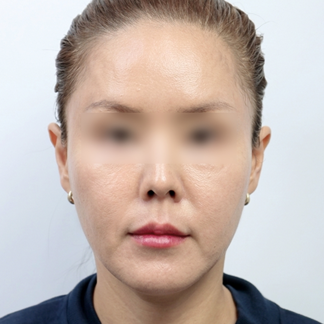 볼·턱선 처짐이 넓게 진행돼 안면거상을 진행한 경우 AFTER · 1 MONTH