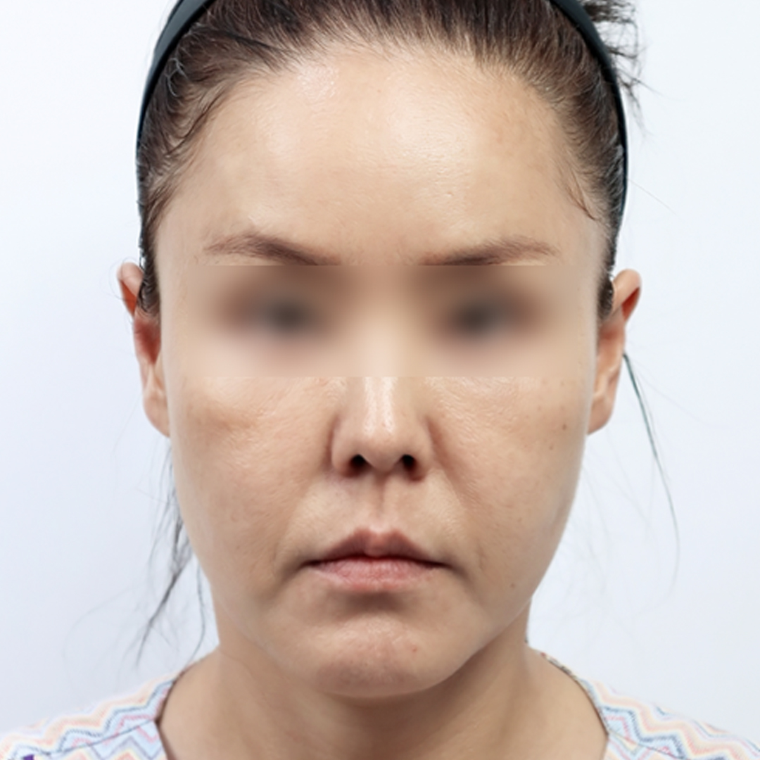 볼·턱선 처짐이 넓게 진행돼 안면거상을 진행한 경우 전