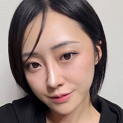 불룩한 지방과 꺼진 눈물고랑이 고민이었던 경우 AFTER · 3 MONTHS