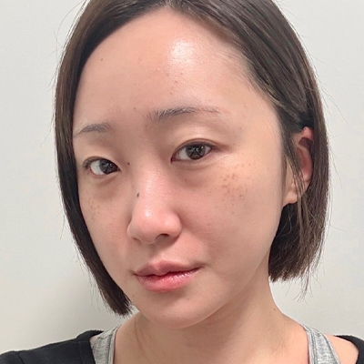 불룩한 지방과 꺼진 눈물고랑이 고민이었던 경우 전