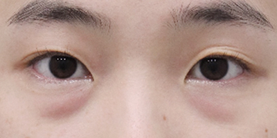 볼록한 눈밑 지방과 눈물고랑이 보이는 눈밑 유형