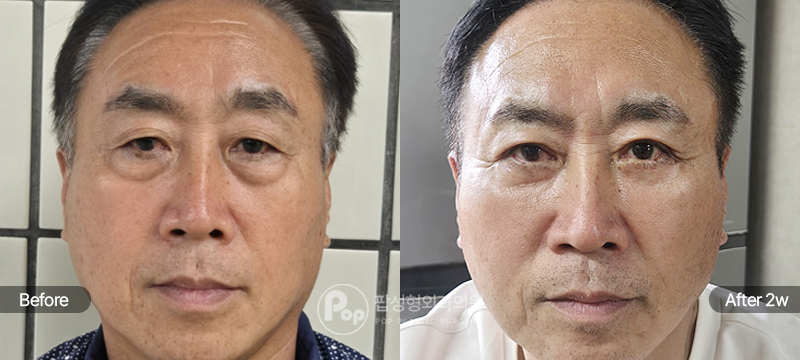 상안검 하안검 2주차 경과 이미지