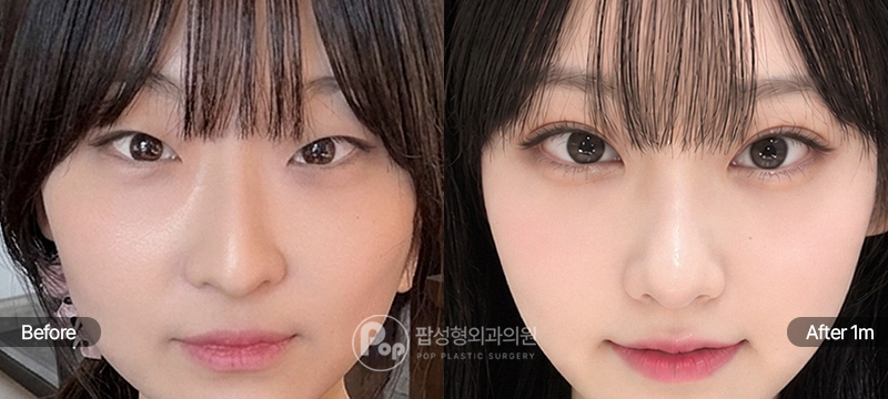 자연유착 눈매교정 앞트임 윗트임 1개월차 경과 이미지