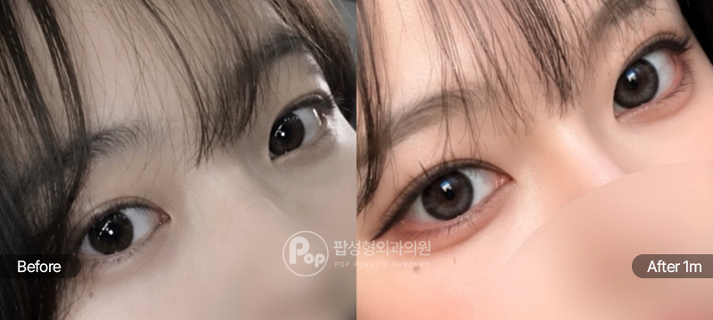 몽고주름이 많고 미간도 넓은 편 유형의 수술 전후 비교 사진