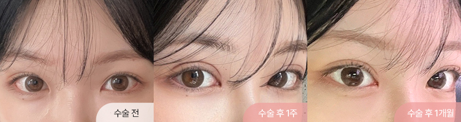 자연유착 눈재수술 앞트임 윗트임 1개월차 경과 이미지