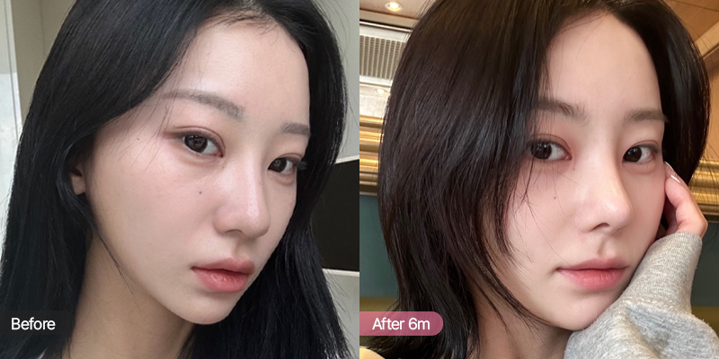 미간이 좁은 얼굴의 코성형 전과 수술 6개월 후 비교