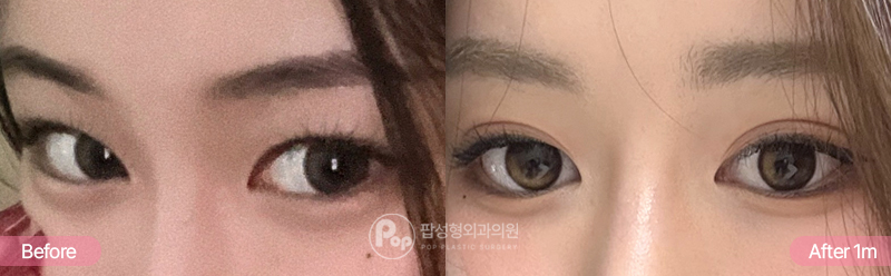 자연유착과 윗트임으로 세미아웃 라인을 만든 수술 전후 1개월 비교