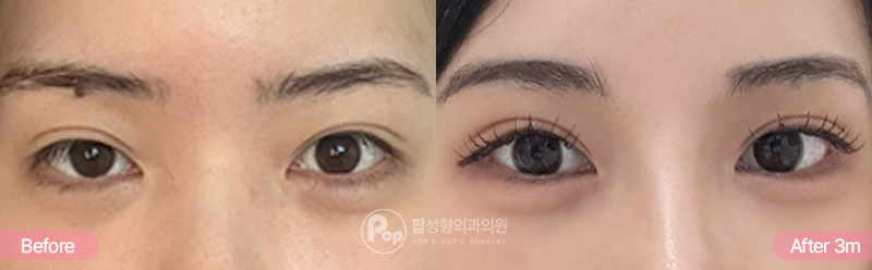 12홀 자연유착 눈재수술 뒤밑트임 3개월차 경과 이미지