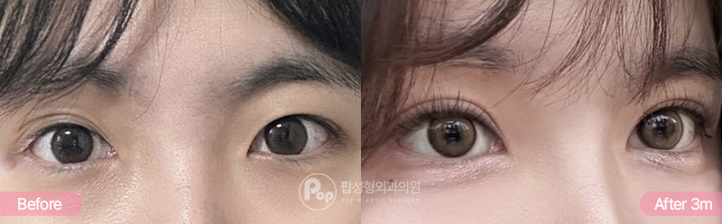 절개 쌍꺼풀 세미아웃라인 3개월차 경과 이미지