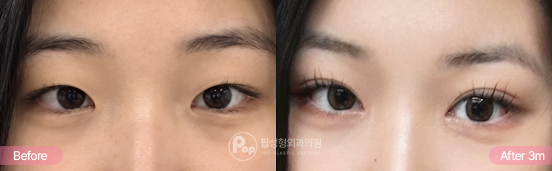 앞머리가 덮인 꼬막눈, 앞트임과 자연유착 쌍꺼풀 진행 전후 (After 2개월)