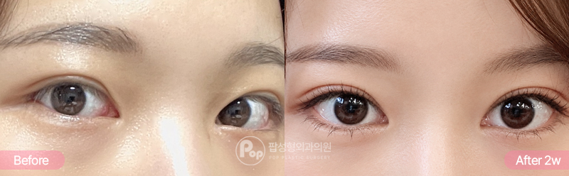 자연유착 눈재수술 눈매교정 윗트임 뒤밑트임 2주차 경과 이미지