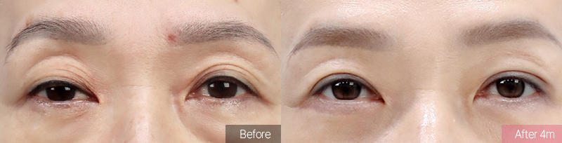 눈 뜨는 힘이 약해진 경우 — 상안검 + 눈매교정 사례
