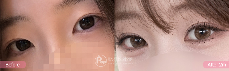 앞뒤 모두 짧은 꼬막눈, 앞·윗·뒤·밑트임과 자연유착 쌍꺼풀 진행 전후 (After 2개월)