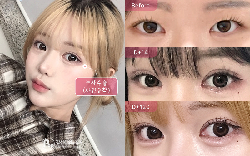 눈재수술 자연유착 눈매교정 윗트임 앞트임 4개월차 경과 이미지